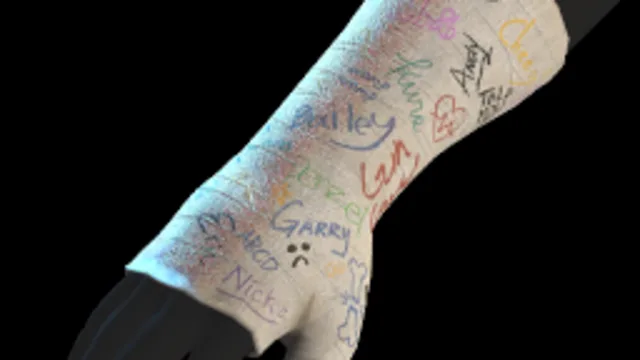 Arm Cast